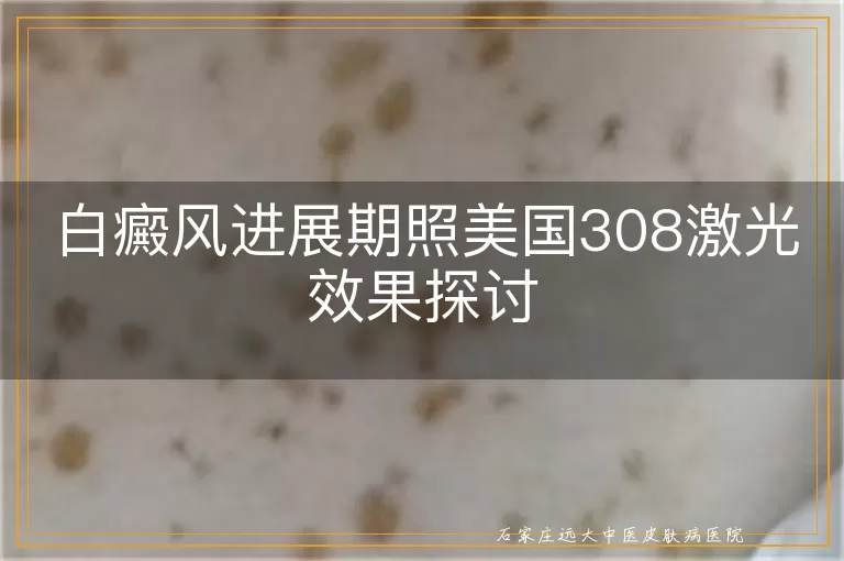 白癜风进展期照美国308激光效果探讨