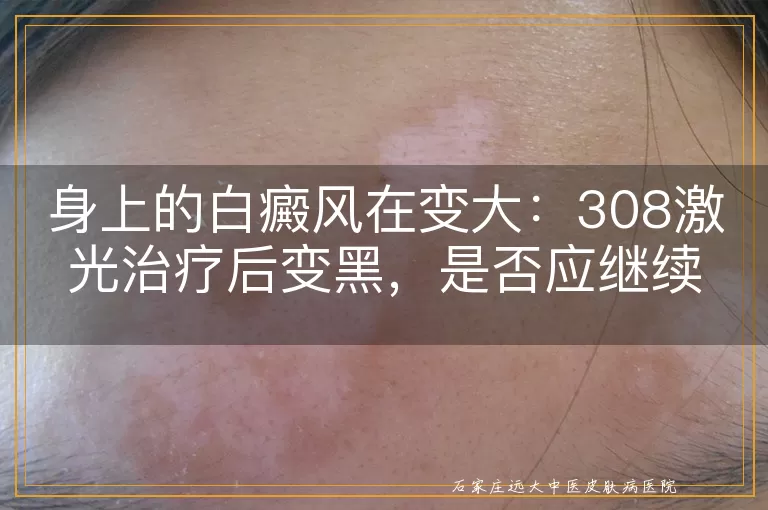 身上的白癜风在变大：308激光治疗后变黑，是否应继续照射？