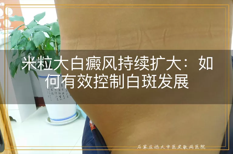 米粒大白癜风持续扩大：如何有效控制白斑发展