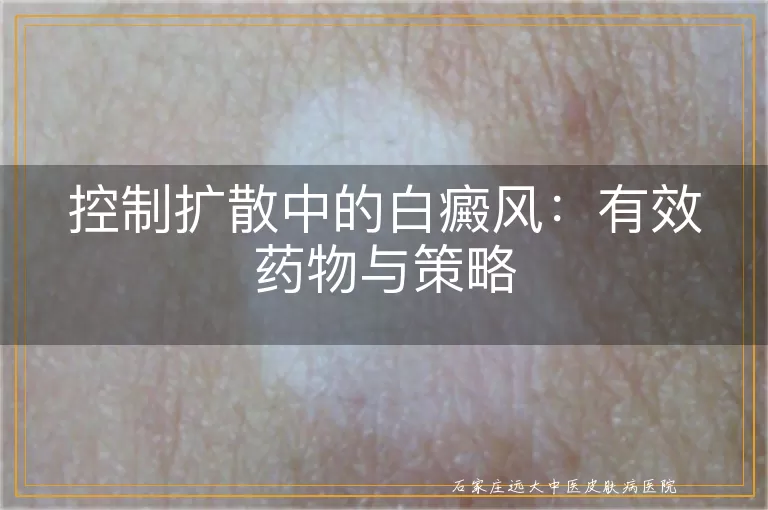 控制扩散中的白癜风：有效药物与策略