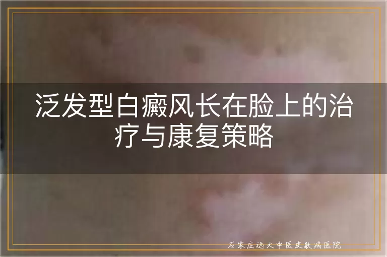 泛发型白癜风长在脸上的治疗与康复策略