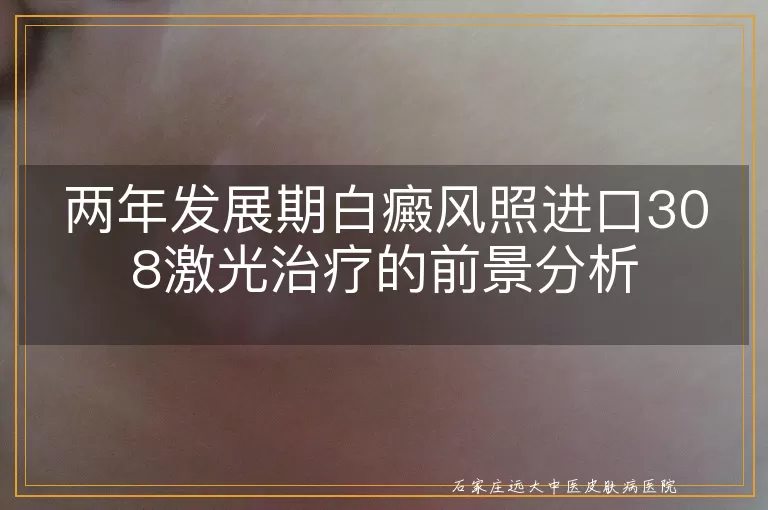 两年发展期白癜风照进口308激光治疗的前景分析