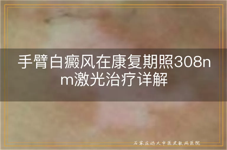 手臂白癜风在康复期照308nm激光治疗详解