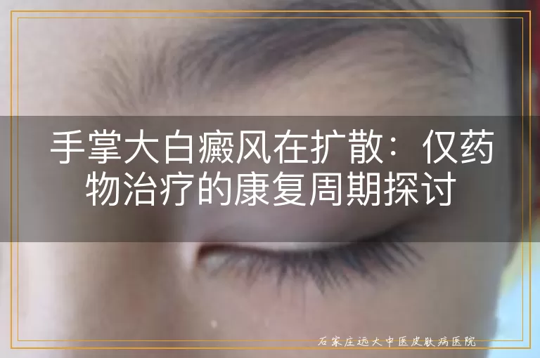 手掌大白癜风在扩散：仅药物治疗的康复周期探讨