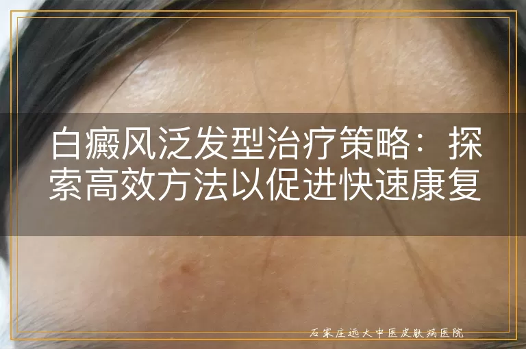 白癜风泛发型治疗策略：探索高效方法以促进快速康复