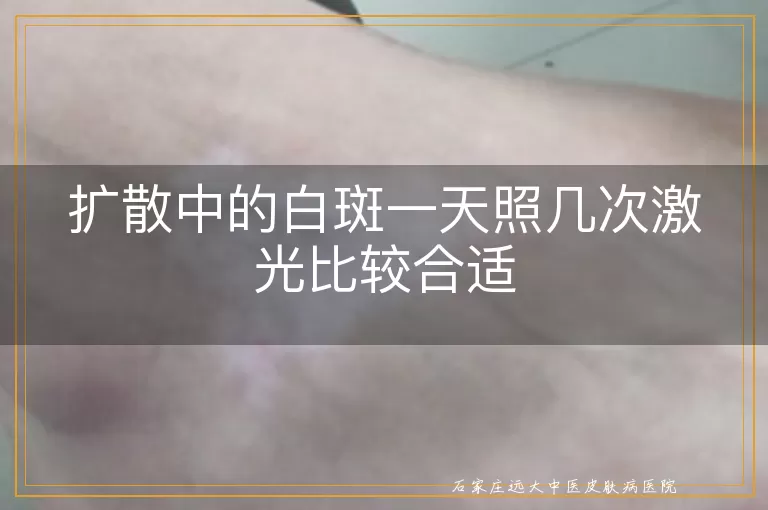 扩散中的白斑一天照几次激光比较合适