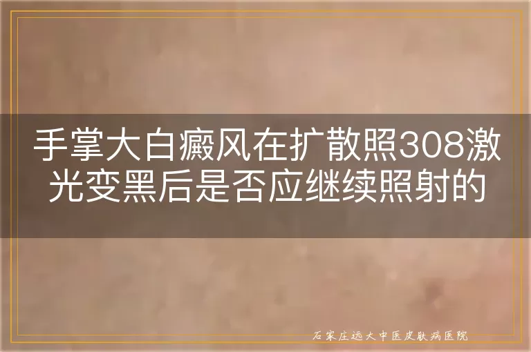 手掌大白癜风在扩散照308激光变黑后是否应继续照射的探讨