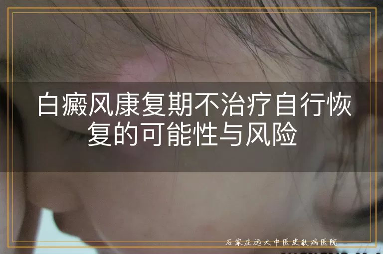 白癜风康复期不治疗自行恢复的可能性与风险