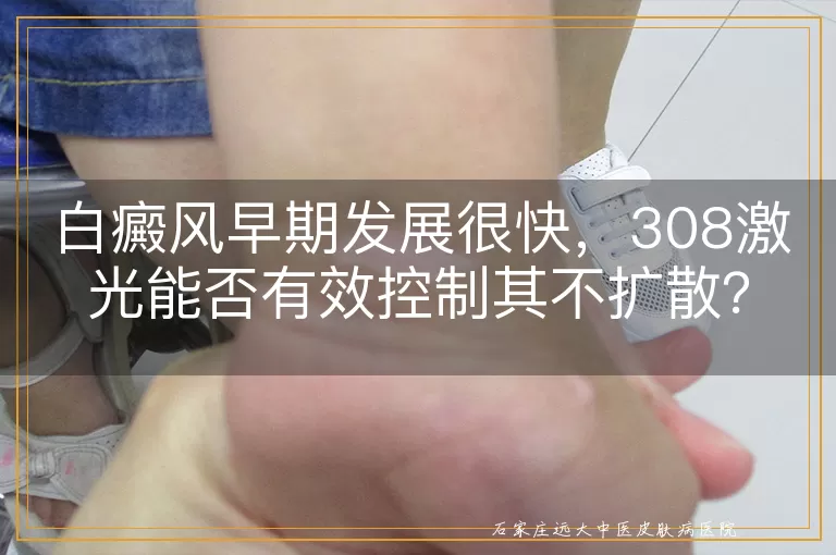 白癜风早期发展很快，308激光能否有效控制其不扩散？