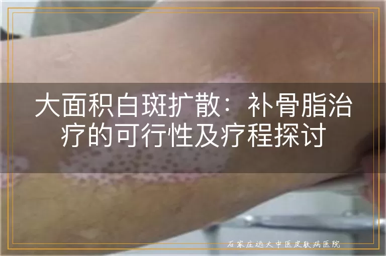 大面积白斑扩散：补骨脂治疗的可行性及疗程探讨