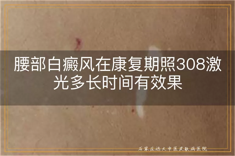 腰部白癜风在康复期照308激光多长时间有效果