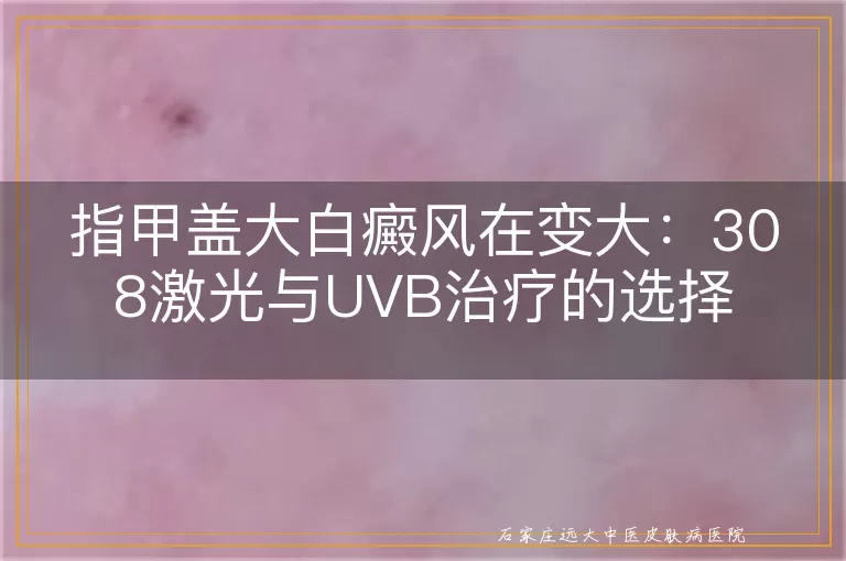指甲盖大白癜风在变大：308激光与UVB治疗的选择