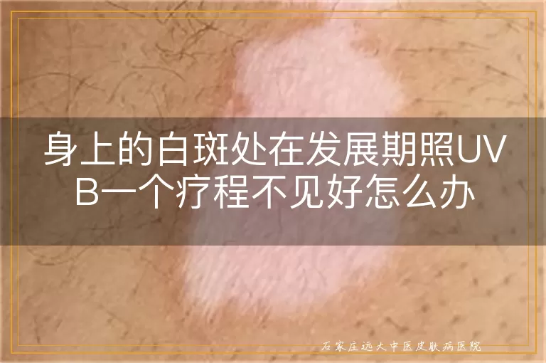 身上的白斑处在发展期照UVB一个疗程不见好怎么办