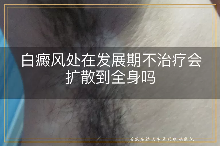 白癜风处在发展期不治疗会扩散到全身吗