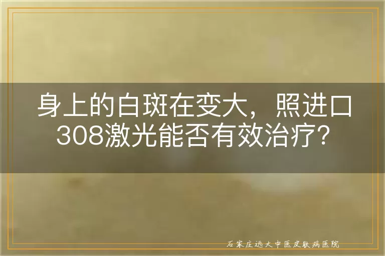 身上的白斑在变大，照进口308激光能否有效治疗？