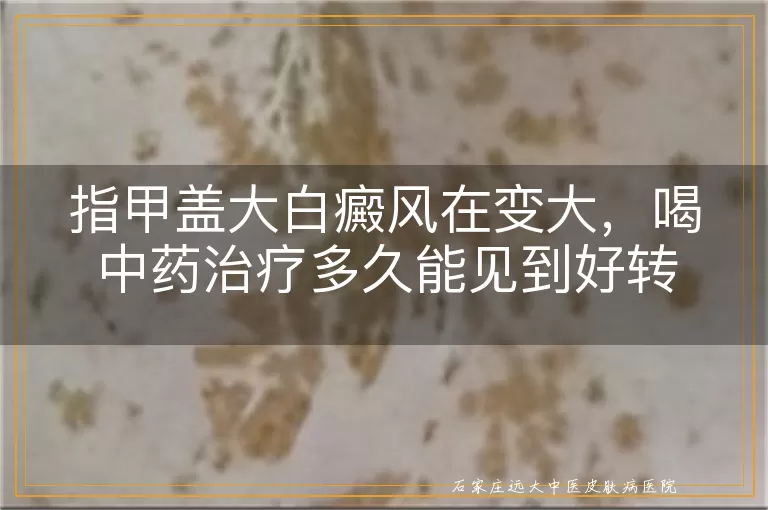 指甲盖大白癜风在变大，喝中药治疗多久能见到好转