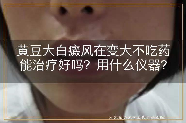 黄豆大白癜风在变大不吃药能治疗好吗？用什么仪器？