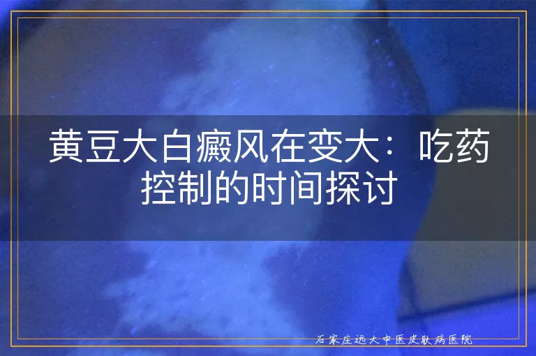 黄豆大白癜风在变大：吃药控制的时间探讨