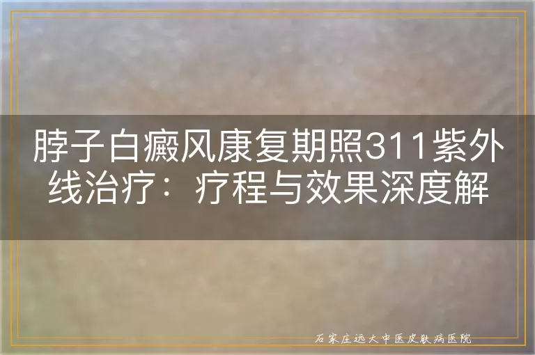 脖子白癜风康复期照311紫外线治疗：疗程与效果深度解析