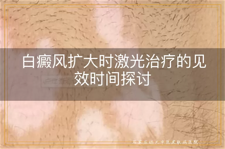白癜风扩大时激光治疗的见效时间探讨