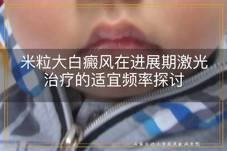 米粒大白癜风在进展期激光治疗的适宜频率探讨