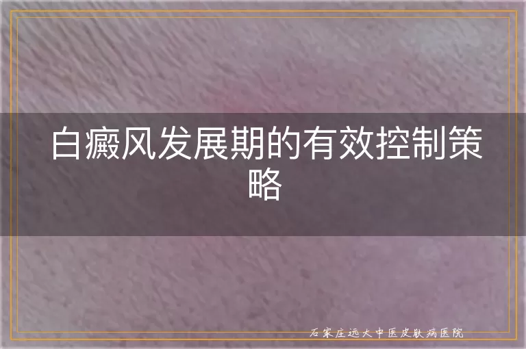 白癜风发展期的有效控制策略