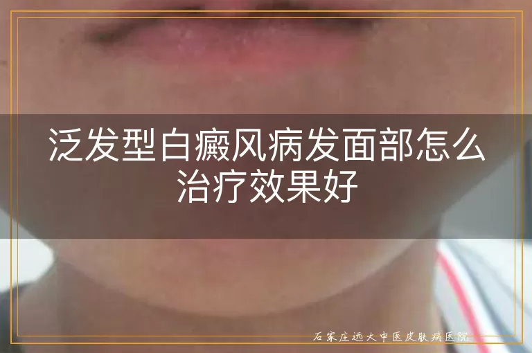泛发型白癜风病发面部怎么治疗效果好