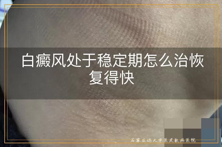 白癜风处于稳定期怎么治恢复得快