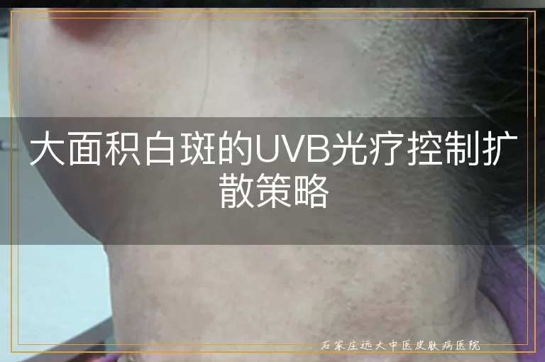 大面积白斑的UVB光疗控制扩散策略