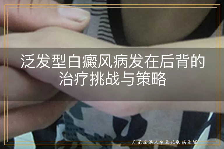 泛发型白癜风病发在后背的治疗挑战与策略