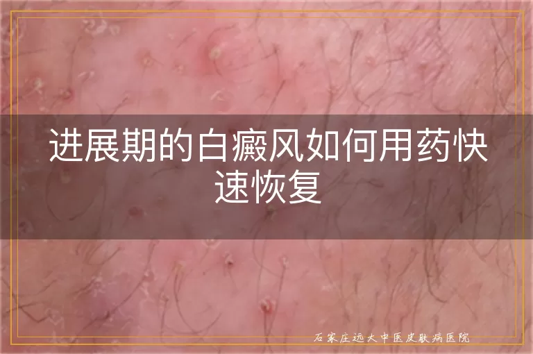 进展期的白癜风如何用药快速恢复