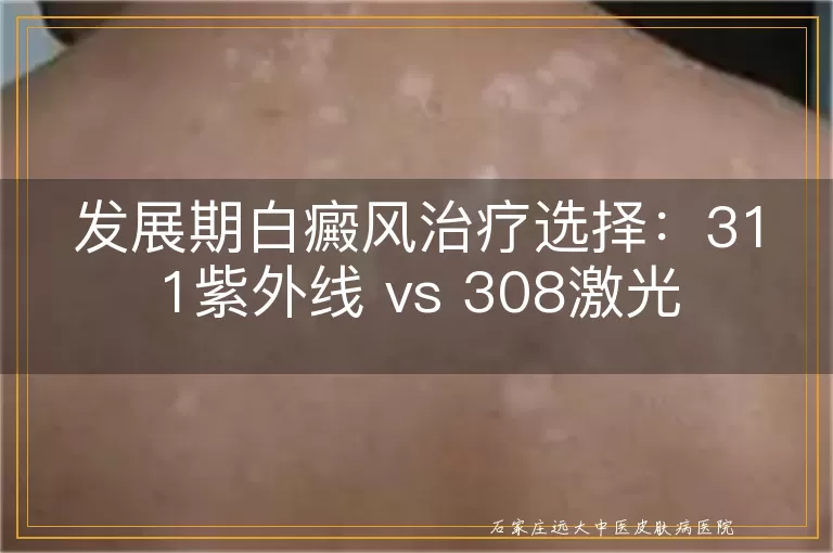 发展期白癜风治疗选择：311紫外线 vs 308激光