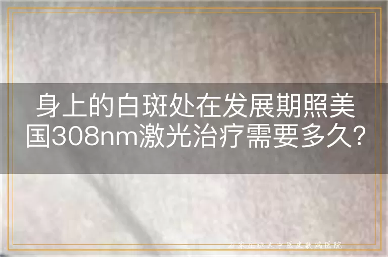 身上的白斑处在发展期照美国308nm激光治疗需要多久？