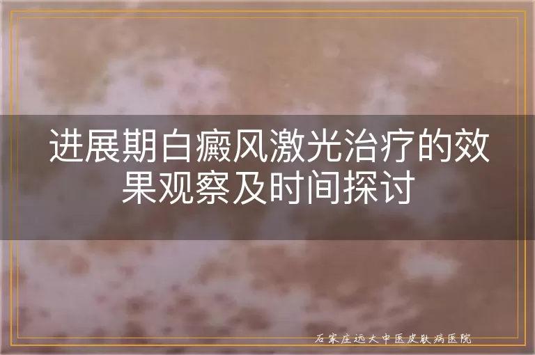 进展期白癜风激光治疗的效果观察及时间探讨