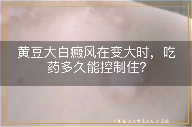 黄豆大白癜风在变大时，吃药多久能控制住？