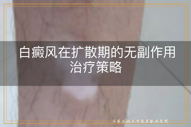 白癜风在扩散期的无副作用治疗策略