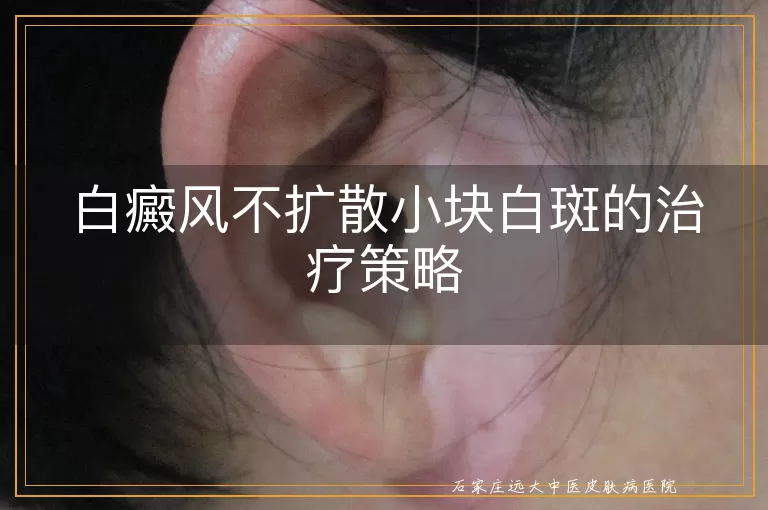 白癜风不扩散小块白斑的治疗策略