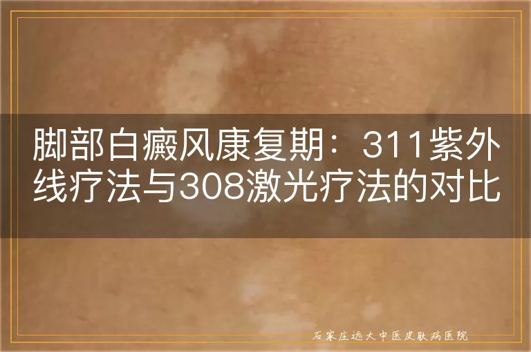 脚部白癜风康复期：311紫外线疗法与308激光疗法的对比评估