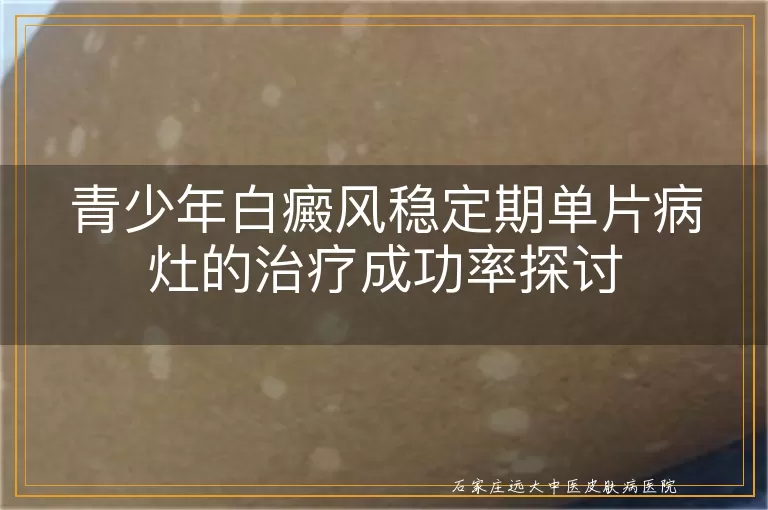 青少年白癜风稳定期单片病灶的治疗成功率探讨