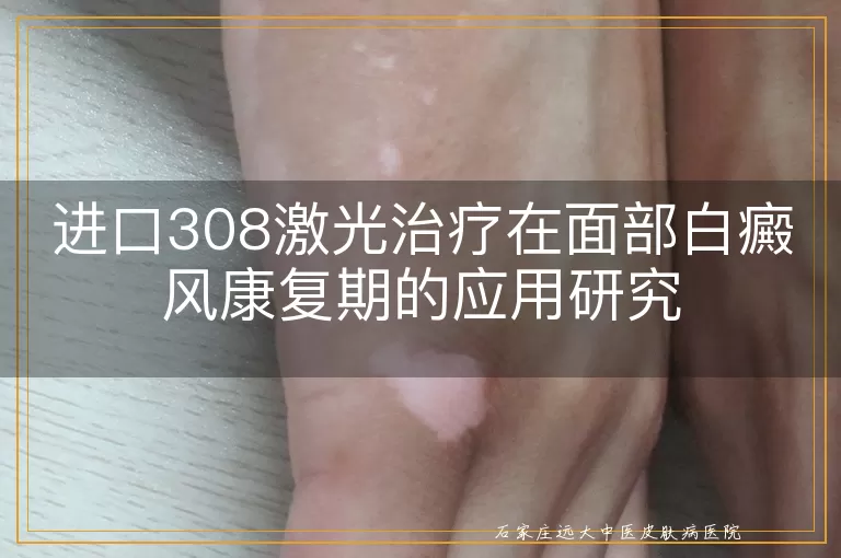 进口308激光治疗在面部白癜风康复期的应用研究