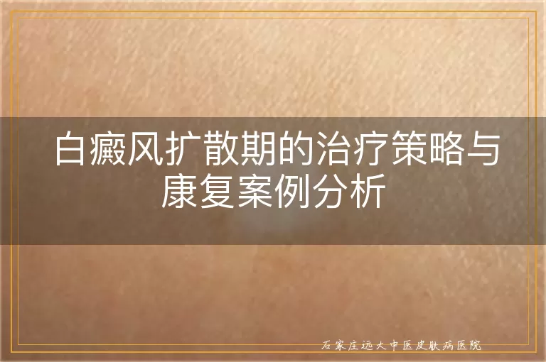 白癜风扩散期的治疗策略与康复案例分析