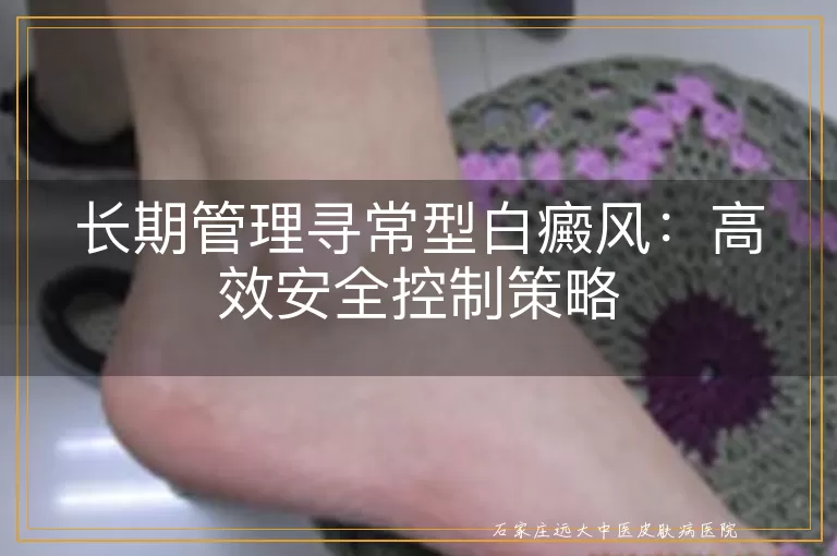 长期管理寻常型白癜风：高效安全控制策略