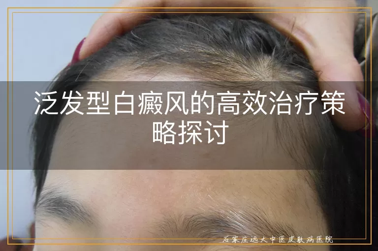 泛发型白癜风的高效治疗策略探讨