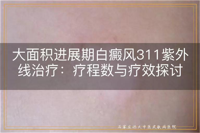 大面积进展期白癜风311紫外线治疗：疗程数与疗效探讨
