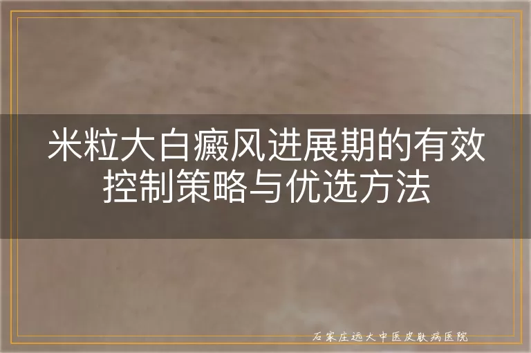 米粒大白癜风进展期的有效控制策略与优选方法