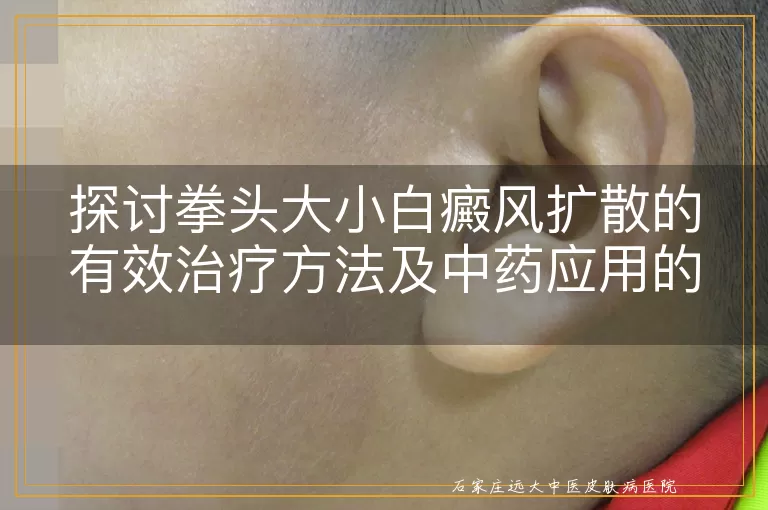 探讨拳头大小白癜风扩散的有效治疗方法及中药应用的可行性
