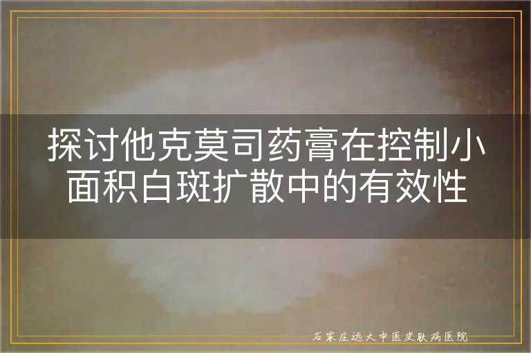 探讨他克莫司药膏在控制小面积白斑扩散中的有效性