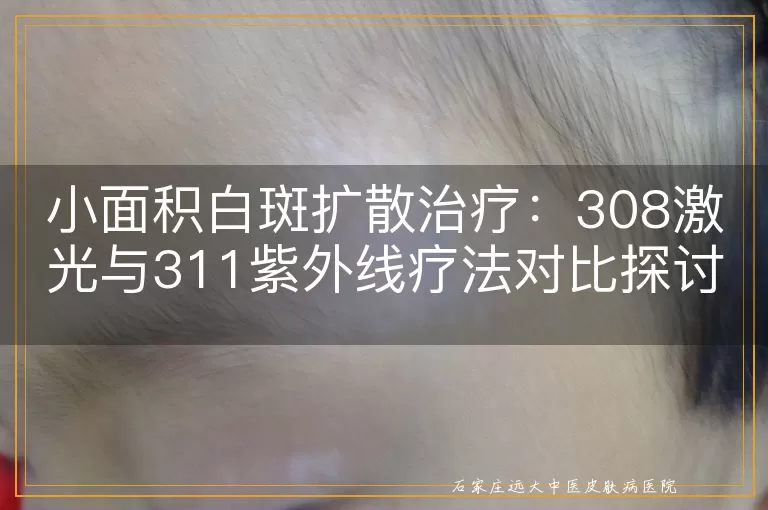 小面积白斑扩散治疗：308激光与311紫外线疗法对比探讨
