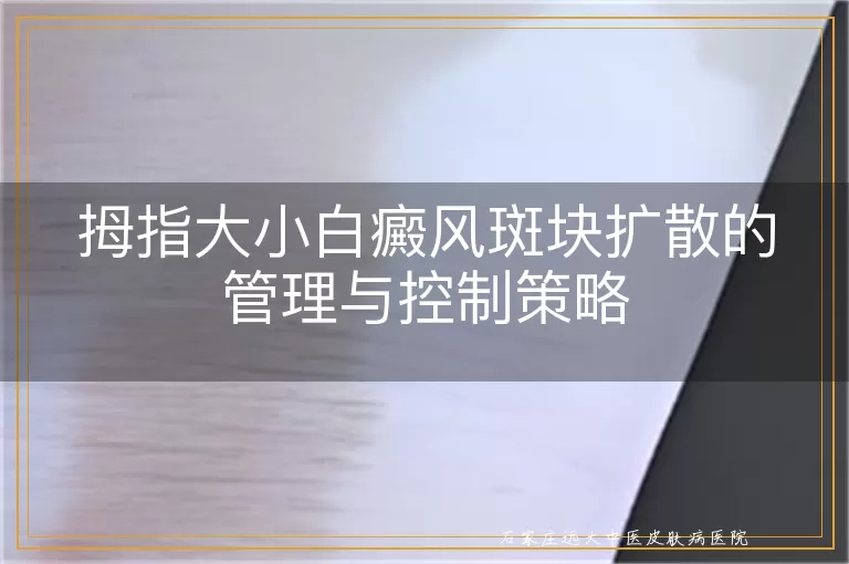 拇指大小白癜风斑块扩散的管理与控制策略