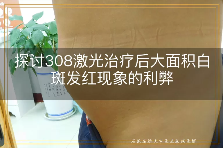 探讨308激光治疗后大面积白斑发红现象的利弊